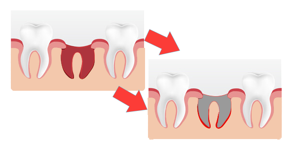 Dry Socket Causes And Management — Josey Lane Dentistry 0574